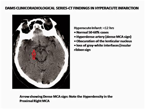 Dense MCA sign-Hyperacute Infarction - Sumer's Radiology Blog