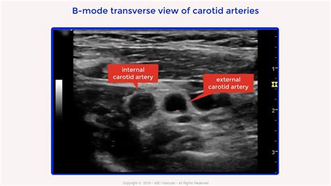 Internal carotid artery chronic occlusion: B-mode and colour Doppler ...