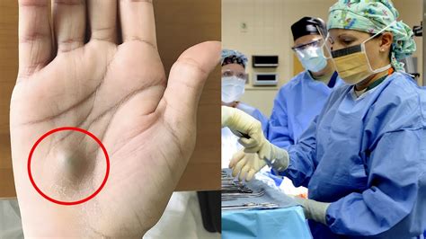 Trend : A Man Found This Strange Lump On His Palm. Then A Scan Revealed ...