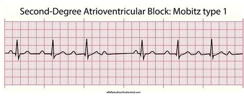 Second-Degree Type I AV Heart Block (Mobitz I Wenckebach) ECG Review