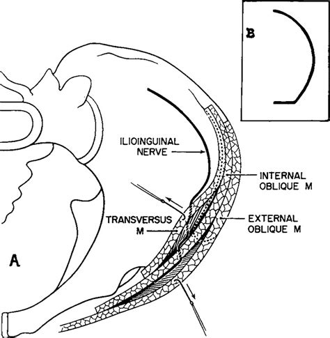 Iliohypogastric Nerve Pain