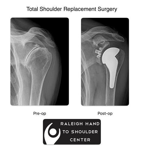 Shoulder Arthritis Treatment in Raleigh | Raleigh Hand to Shoulder Center