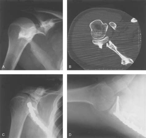 Fractures of the Scapula | Musculoskeletal Key