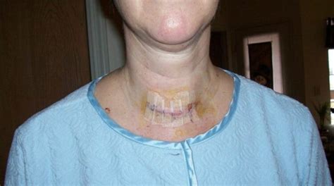 Here's What To Expect After Thyroid Surgery - My Post Thyroid Surgery ...