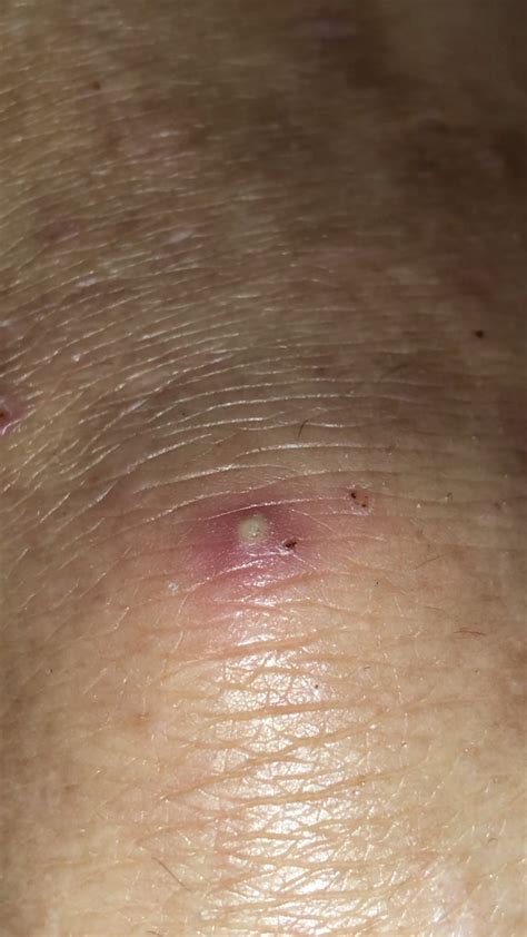 Knee pop! : r/popping