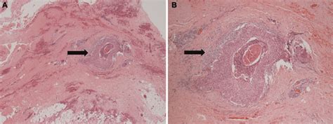 What if a surgically removed neck lymph node turns out to be cancer ...