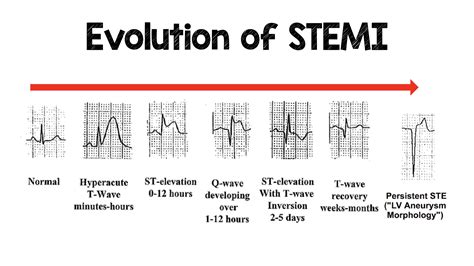 Ecg Changes With Stemi | Images and Photos finder