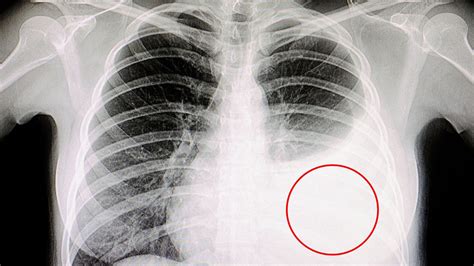 What Is the Cause of Persistent Pleuritis in Lung Cancer Patient ...