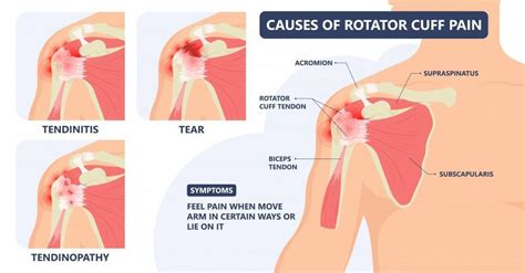 Rotator Cuff Injury Including Rotator Cuff Tear, Rotator Cuff Bursitis ...