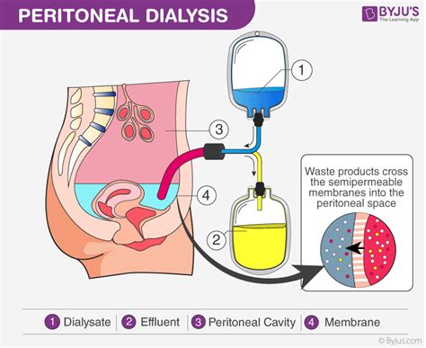 Peritoneal Dialysis- Types and Process of Peritoneal Dialysis