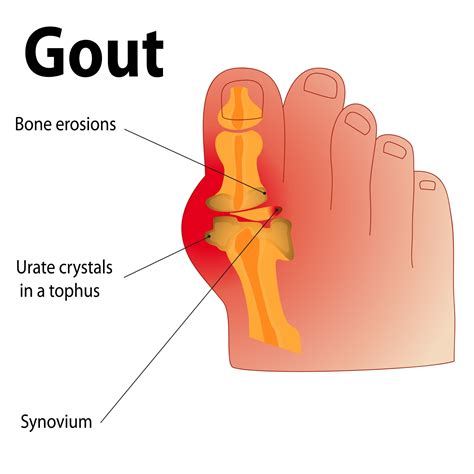 Gout - Casteel Foot & Ankle Center