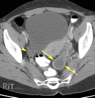 RiT radiology: Tubo-ovarian Abscess