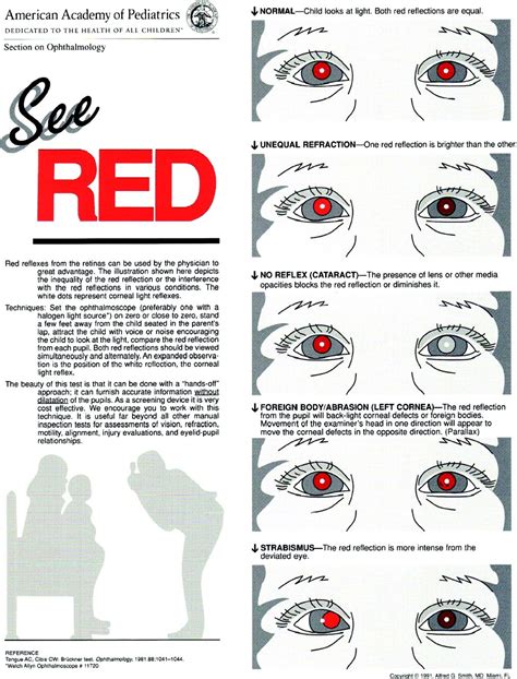 Corneal Light Reflex Abnormal Findings