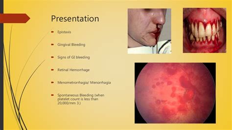 Idiopathic Thrombocytopenic Purpura