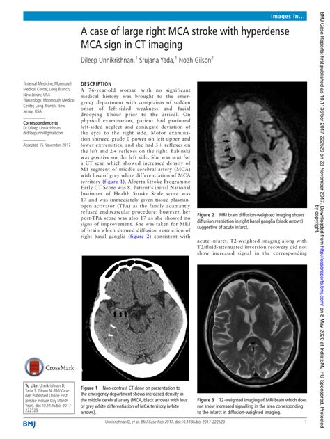 (PDF) A case of large right MCA stroke with hyperdense MCA sign in CT ...