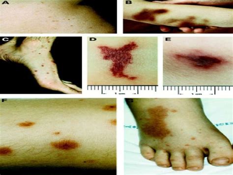 Paroxysmal nocturnal hemoglobinuria