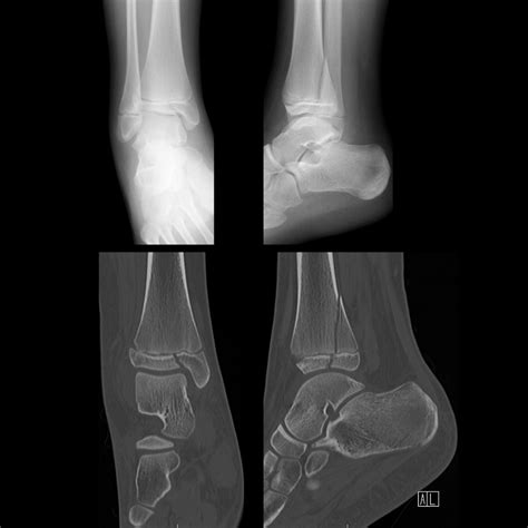 Triplane Fracture | Pediatric Radiology Reference Article | Pediatric ...