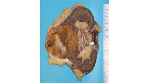 Oncocytoma of Kidney