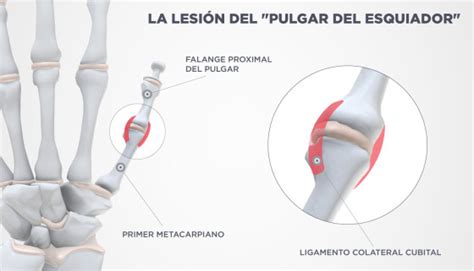 LESIONES DE LOS LIGAMENTOS DEL DEDO PULGAR - UNITRAUMA