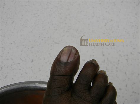 Longitudinal brown band on the toenail. (click images for higher ...