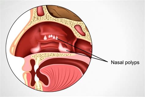 Nasal Polyps – NuLife Hospital – Gastroenterology, Liver Diseases ...