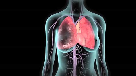 What are the Signs of a Pulmonary Embolism and Treatment Options ...