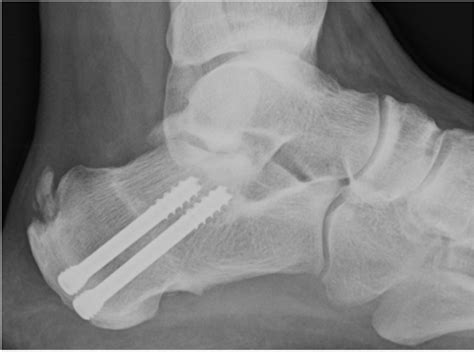 Postoperative X-ray of a dorsal wedge calcaneal osteotomy fixed with 2 ...