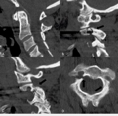 A CT scan of the cervical spine of a healthy, 61-year-old woman ...