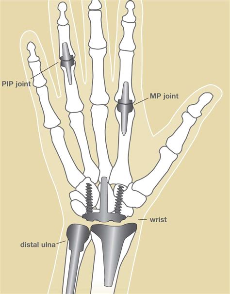 Joint Replacement