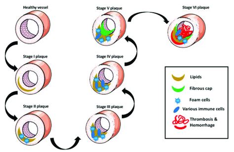 Atherosclerosis Stages