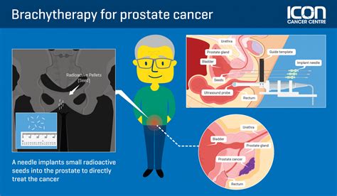 Focal brachytherapy for prostate cancer — Icon Cancer Centre