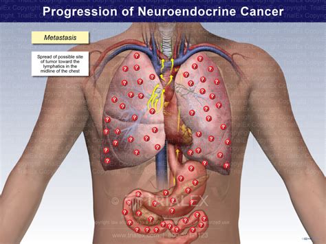 Progression of Neuroendocrine Tumor - TrialExhibits Inc.