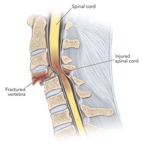 Spinal Cord Injury | Neurosurgeon | Expert Surgeon | Aaron Cohen-Gadol, MD