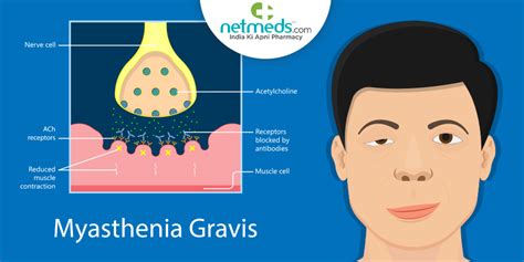 Myasthenia Gravis: Causes, Symptoms And Treatment Of This Autoimmune ...