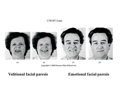 Emotional facial paresis