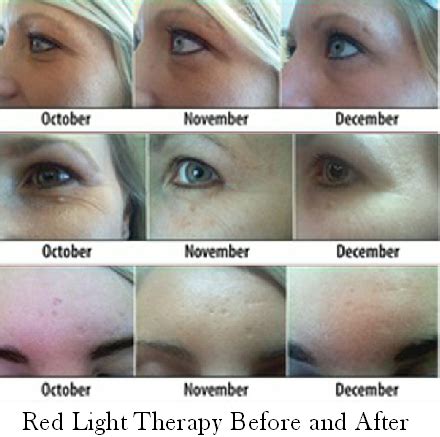 Red & Yellow Light Therapy Seriously Fights Aging