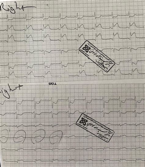 Posterior and right-sided ECG leads in the first electrocardiogram from ...