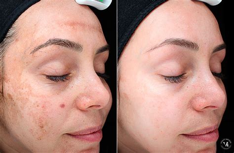 Chemical Peels Photos | Houston, Tx | Patient 10795