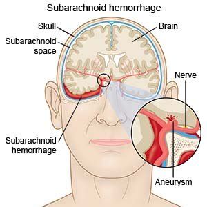 Subarachnoid Hemorrhage - What You Need to Know