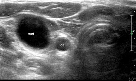 Ultrasound image of enlarged lymph node in level III of the right neck ...