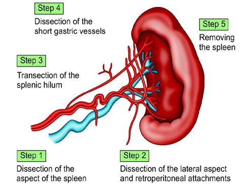 Laparoscopic Splenectomy Surgical Technique