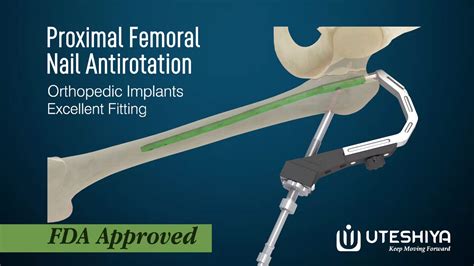 PFNA: Advancing Femoral Fracture Treatment with Proximal Femoral Nail ...