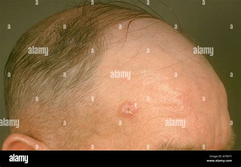 Rodent Ulcer High Resolution Stock Photography and Images - Alamy