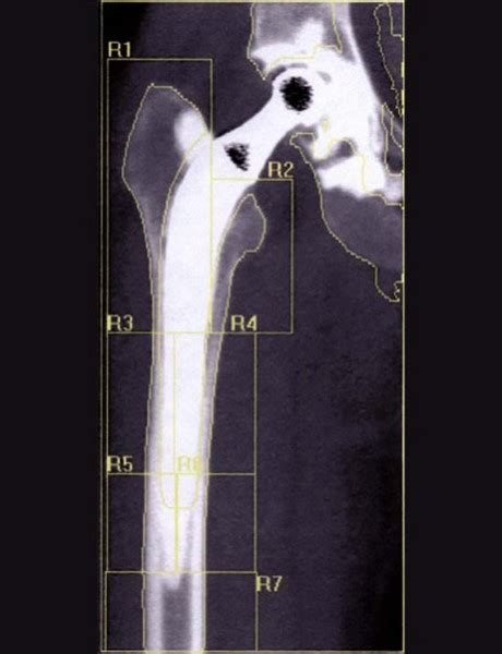 Servicio de Densitometría Ósea - Diagnostico Maipú