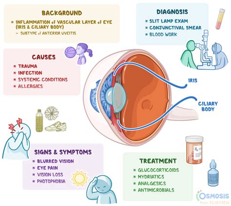 Anterior Uveitis: Symptoms, Treatment And More, 54% OFF