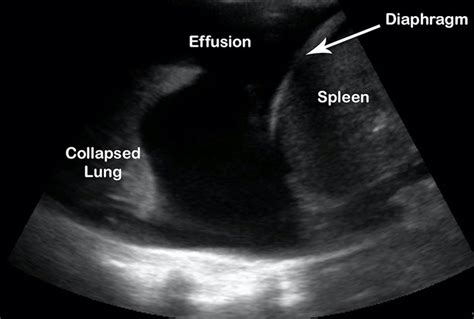 Pleural Effusion On Ultrasound