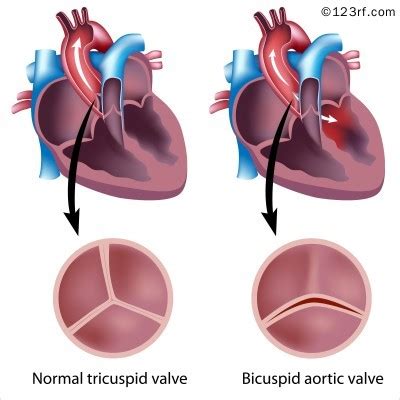 Heart valve disease module 4: diagnosis - The British Journal of Cardiology