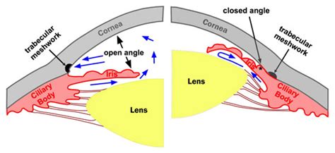 Closed angle glaucoma an explanation | Melbourne Eye Centre