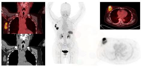 Diagnostics | Free Full-Text | The Role of PET/CT in Breast Cancer