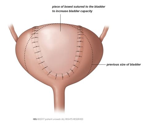 Second-line treatment for overactive bladder - Patient Information